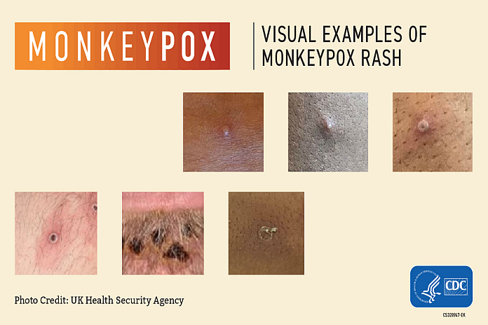 Caribbean News Global monkeypox_cdc-1 Monkeypox: The naked truth  